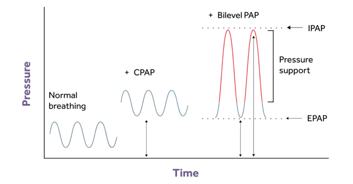 Diagaram showing the difference between CPAP and BiLevel